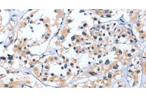 Immunohistochemistry of paraffin-embedded Human thyroid cancer tissue using EDN3 Polyclonal Antibody at dilution 1:30 (Endothelin 3 抗体)