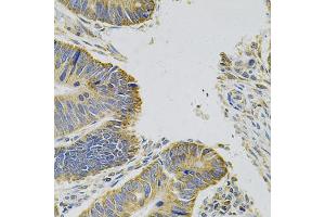 Immunohistochemistry of paraffin-embedded human colon carcinoma using MYD88 Antibody (ABIN6290608) at dilution of 1:100 (40x lens). (MYD88 抗体)