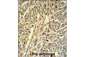 IDH2 Antibody (Center) (ABIN391584 and ABIN2841516) IHC analysis in formalin fixed and paraffin embedded human Lung carcinoma followed by peroxidase conjugation of the secondary antibody and DAB staining. (IMPDH2 抗体  (AA 180-210))