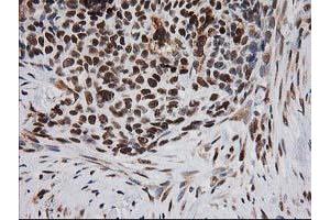 Immunohistochemical staining of paraffin-embedded Adenocarcinoma of Human breast tissue using anti-ERCC4 mouse monoclonal antibody. (ERCC4 抗体)