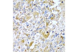 Immunohistochemistry of paraffin-embedded human lung cancer using HAVCR2 antibody at dilution of 1:100 (x40 lens). (TIM3 抗体)
