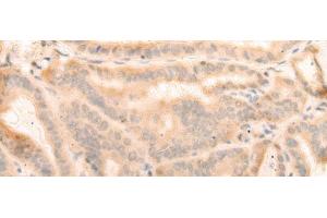 Immunohistochemistry of paraffin-embedded Human thyroid cancer tissue using ELP4 Polyclonal Antibody at dilution of 1:25(x200) (ELP4 抗体)