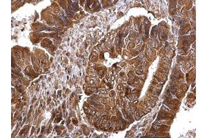 IHC-P Image Thymidylate synthetase antibody detects Thymidylate synthetase protein at cytosol and nucleus on human colon carcinoma by immunohistochemical analysis. (TYMS 抗体)