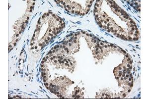 Immunohistochemical staining of paraffin-embedded Adenocarcinoma of Human ovary tissue using anti-ERCC1 mouse monoclonal antibody. (ERCC1 抗体)