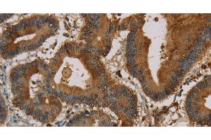 Immunohistochemistry of paraffin-embedded Human colon cancer using CK-16 Polyclonal Antibody at dilution of 1:30 (KRT16 抗体)