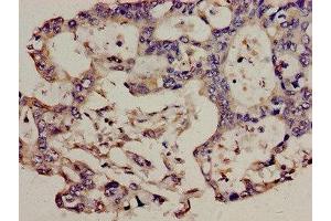 Immunohistochemistry analysis of human pancreatic cancer using ABIN7171289 at dilution of 1:100 (TCRb 抗体  (AA 22-115))