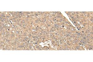 Immunohistochemistry of paraffin-embedded Human liver cancer tissue using BDH2 Polyclonal Antibody at dilution of 1:65(x200) (BDH2 抗体)