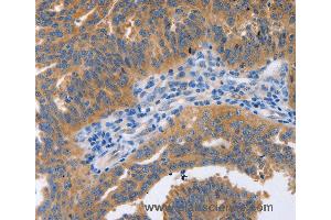 Immunohistochemistry of Human cervical cancer using NBEA Polyclonal Antibody at dilution of 1:60 (Neurobeachin 抗体)