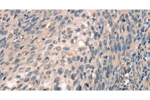 Immunohistochemistry of paraffin-embedded Human cervical cancer tissue using CDK12 Polyclonal Antibody at dilution 1:30 (CDK12 抗体)