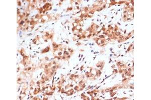 Immunohistochemistry of paraffin-embedded Human liver cancer using Phospho-STAT1(S727) Polyclonal Antibody at dilution of 1:100 (40x lens).