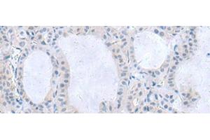 Immunohistochemistry of paraffin-embedded Human thyroid cancer tissue using IL1B Polyclonal Antibody at dilution of 1:55(x200)