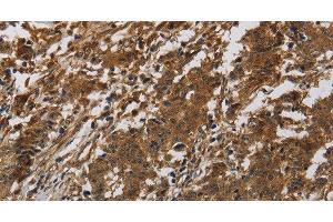 Immunohistochemistry of paraffin-embedded Human liver cancer tissue using ITGB7 Polyclonal Antibody at dilution of 1:40 (Integrin beta 7 抗体)