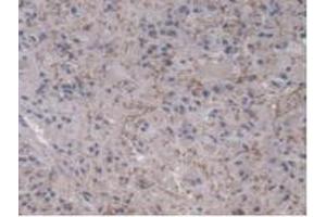 Detection of UBE2L3 in Human Glioma Tissue using Polyclonal Antibody to Ubiquitin Conjugating Enzyme E2L3 (UBE2L3) (UBE2L3 抗体  (AA 4-154))