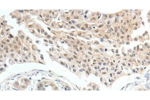 Immunohistochemistry of paraffin-embedded Human lung cancer tissue using MDK Polyclonal Antibody at dilution 1:60 (Midkine 抗体)
