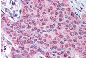 Human Breast Carcinoma (formalin-fixed, paraffin-embedded) stained with MMP13 antibody ABIN290538 at 50 ug/ml followed by biotinylated goat anti-rabbit IgG secondary antibody ABIN481713, alkaline phosphatase-streptavidin and chromogen. (MMP13 抗体  (C-Term))