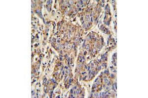 Formalin-fixed and paraffin-embedded human hepatocarcinoma with CATB Antibody (Center), which was peroxidase-conjugated to the secondary antibody, followed by DAB staining. (Tyrosinase-Related Protein 1 抗体  (AA 198-227))