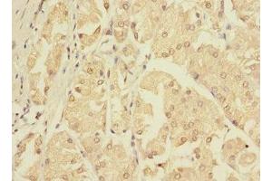Immunohistochemistry of paraffin-embedded human gastric cancer using ABIN7176445 at dilution of 1:100 (ZNF624 抗体  (AA 127-327))