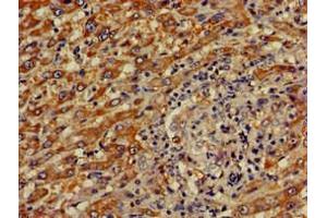 Immunohistochemistry of paraffin-embedded human liver cancer using ABIN7148816 at dilution of 1:100 (CREB3L1 抗体  (AA 396-500))