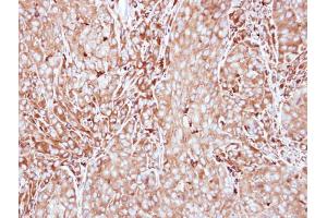 IHC-P Image Immunohistochemical analysis of paraffin-embedded A549 xenograft, using MMP3, antibody at 1:500 dilution. (MMP3 抗体)