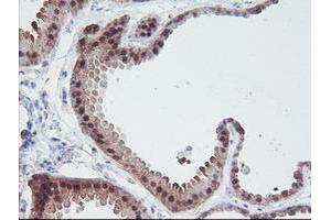 Immunohistochemical staining of paraffin-embedded Human breast tissue using anti-IRF6 mouse monoclonal antibody. (IRF6 抗体)