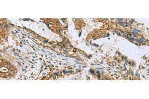 Immunohistochemistry of paraffin-embedded Human cervical cancer tissue using TUBD1 Polyclonal Antibody at dilution of 1:70(x200) (TUBD1 抗体)