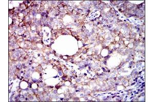 Immunohistochemical analysis of paraffin-embedded cervical cancer tissues using ITGB1 mouse mAb with DAB staining.
