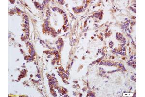 Formalin-fixed and paraffin embedded human gastric carcinoma labeled with Anti GNA12/G protein alpha 12 Polyclonal Antibody, Unconjugated (ABIN753958) at 1:200 followed by conjugation to the secondary antibody and DAB staining (GNA12 抗体  (AA 301-381))