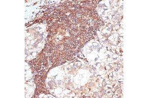 Immunohistochemistry of paraffin-embedded human liver cancer using G3BP1 antibody (ABIN7267528) at dilution of 1:100 (40x lens).
