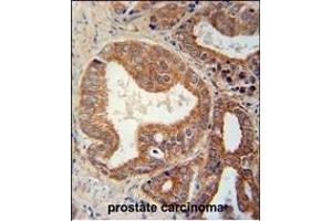CSGALNACT1 Antibody (Center) (ABIN651115 and ABIN2840081) immunohistochemistry analysis in formalin fixed and paraffin embedded human prostate carcinoma followed by peroxidase conjugation of the secondary antibody and DAB staining. (CSGALNACT1 抗体  (AA 192-220))