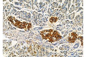ABIN7093901 and ABIN7097945 at 1/100 staining Human gastric cancer and adjacent non-tumor tissue by IHC-P. (IMPDH1 抗体  (C-Term))