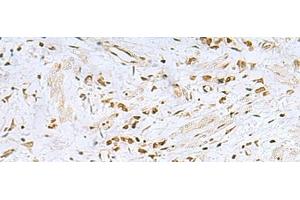 Immunohistochemistry of paraffin-embedded Human gastric cancer tissue using FOXQ1 Polyclonal Antibody at dilution of 1:25(x200) (FOXQ1 抗体)