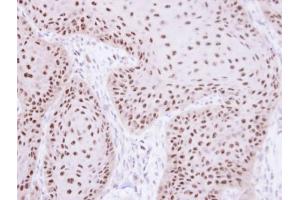 IHC-P Image Immunohistochemical analysis of paraffin-embedded Cal27 xenograft, using RPA 70 kDa subunit , antibody at 1:100 dilution. (RPA1 抗体  (C-Term))