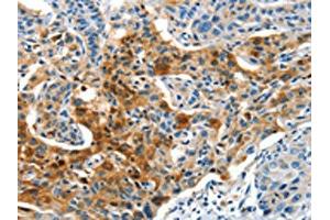 The image on the left is immunohistochemistry of paraffin-embedded Human lung cancer tissue using ABIN7190321(COG1 Antibody) at dilution 1/60, on the right is treated with synthetic peptide. (COG1 抗体)