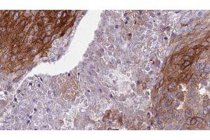 ABIN6276819 at 1/100 staining Human urothelial cancer tissue by IHC-P. (S100A8 抗体  (C-Term))