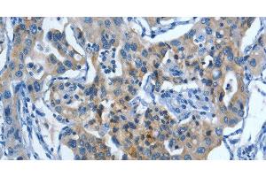 Immunohistochemistry of paraffin-embedded Human lung cancer tissue using MUC15 Polyclonal Antibody at dilution 1:50 (MUC15 抗体)