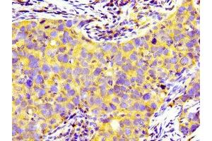 Immunohistochemistry of paraffin-embedded human pancreatic cancer using ABIN7158932 at dilution of 1:100 (PRNP 抗体  (AA 23-64))