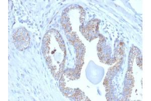 Formalin-fixed, paraffin-embedded human Prostate Carcinoma stained with PMEPA1 Mouse Monoclonal Antibody (PMEPA1/2697). (PMEPA1 抗体)