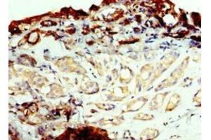 Immunohistochemistry of paraffin-embedded human breast cancer using ABIN7143737 at dilution of 1:100 (FUT6 抗体  (AA 170-359))