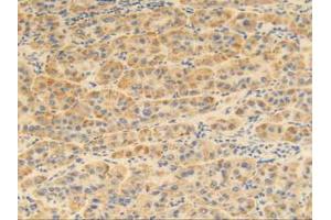 IHC-P analysis of Human Liver Cancer Tissue, with DAB staining. (MGP 抗体  (AA 1-103))