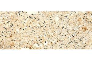 Immunohistochemistry of paraffin-embedded Human prost ate cancer tissue using GLYATL2 Polyclonal Antibody at dilution of 1:50(x200) (GLYATL2 抗体)