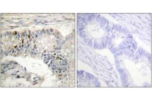 Immunohistochemistry analysis of paraffin-embedded human colon carcinoma tissue, using Histone H1 (Ab-17) Antibody. (Histone H1 抗体  (AA 1-50))