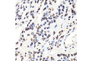 Immunohistochemistry of paraffin-embedded human oophoroma using Phospho-STA-Y694 antibody (ABIN6135328, ABIN6136272, ABIN6136273 and ABIN7101887) at dilution of 1:100 (40x lens). (STAT5A 抗体  (pTyr694))
