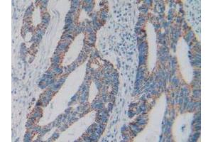 IHC-P analysis of Human Rectum Cancer Tissue, with DAB staining. (C1QBP 抗体  (AA 76-282))
