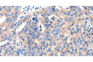 Immunohistochemistry of paraffin-embedded Human ovarian cancer tissue using KLK2 Polyclonal Antibody at dilution 1:100 (Kallikrein 2 抗体)