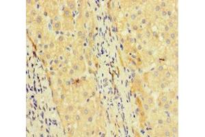 Immunohistochemistry of paraffin-embedded human liver cancer using ABIN7172463 at dilution of 1:100 (TCF4 抗体  (AA 419-525))