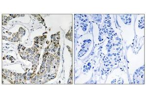 Immunohistochemistry analysis of paraffin-embedded human breast carcinoma tissue using BLK (Phospho-Tyr501) antibody. (BLK 抗体  (pTyr501))