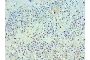 Immunohistochemistry of paraffin-embedded human breast cancer using ABIN7173326 at dilution of 1:100 (TFF1 抗体  (AA 25-84))