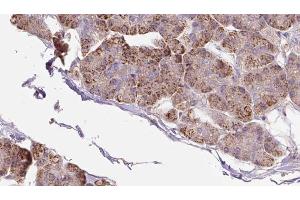 ABIN6273285 at 1/100 staining Human pancreas cancer tissue by IHC-P. (PACS2 抗体  (Internal Region))