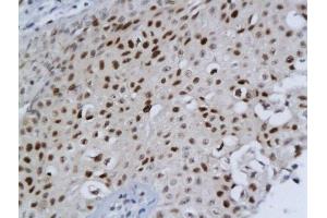 Formalin-fixed and paraffin embedded human bladder cancer labeled with Anti-DBC1/DELETED IN BLADDER CANCER 1 Polyclonal Antibody, Unconjugated  followed by conjugation to the secondary antibody and DAB staining (DBC1 抗体  (AA 101-200))