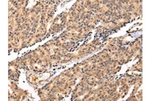 The image on the left is immunohistochemistry of paraffin-embedded Human prostate cancer tissue using ABIN7131260(SWAP70 Antibody) at dilution 1/20, on the right is treated with fusion protein. (SWAP7 抗体)
